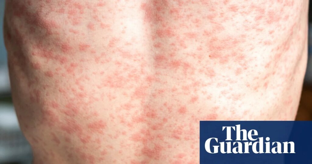 How contagious is measles and what are the symptoms? | well actually How contagious is measles and what are the symptoms? | well actually