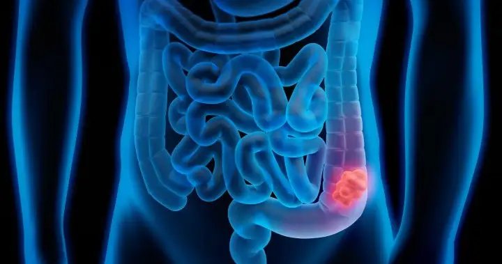 American cancer society recommends blood screening for colorectal cancer - national American cancer society recommends blood screening for colorectal cancer - national